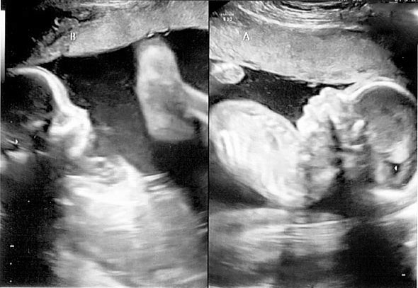 My boys at 22 weeks- they’ll be here before we know it! #DotseyDuo #pregnant #ultrasound #twinning #twins