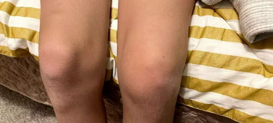 Milly’s Knee